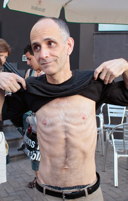 Journalist José Luis García Paneque is emaciated after years of mistreatment in Cuban prisons. (AP/Arturo Rodriguez).