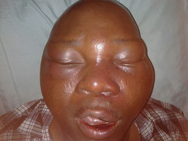Nigerian magazine publisher Yomi Olomofe after his assault in June 2015 (Photo: Yomi Olomofe).