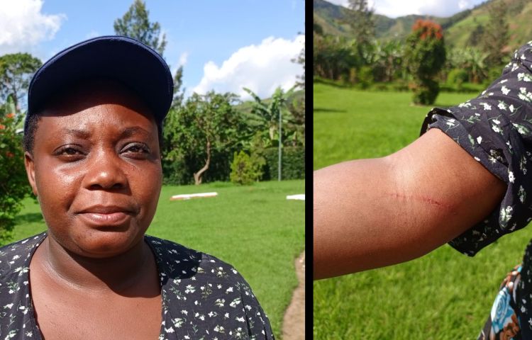 Freelance reporter Juliet Kyarisiima sustained a cut to her arm when she was assaulted by three armed men on May 12, in Uganda’s western Buhweju District, while covering a public meeting. (Photo courtesy of Juliet Kyarisiima)