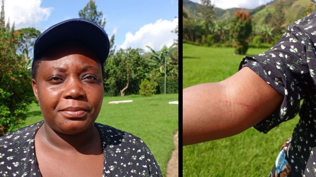 Freelance reporter Juliet Kyarisiima sustained a cut to her arm when she was assaulted by three armed men on May 12, in Uganda’s western Buhweju District, while covering a public meeting. (Photo courtesy of Juliet Kyarisiima)