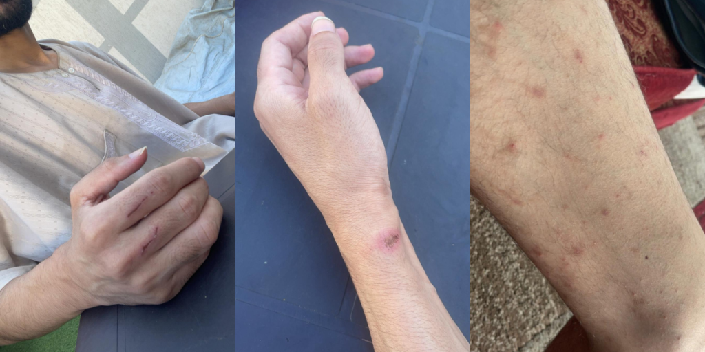 Images show some of the injuries journalist Shadi Abu Sido reported sustaining while in prison.