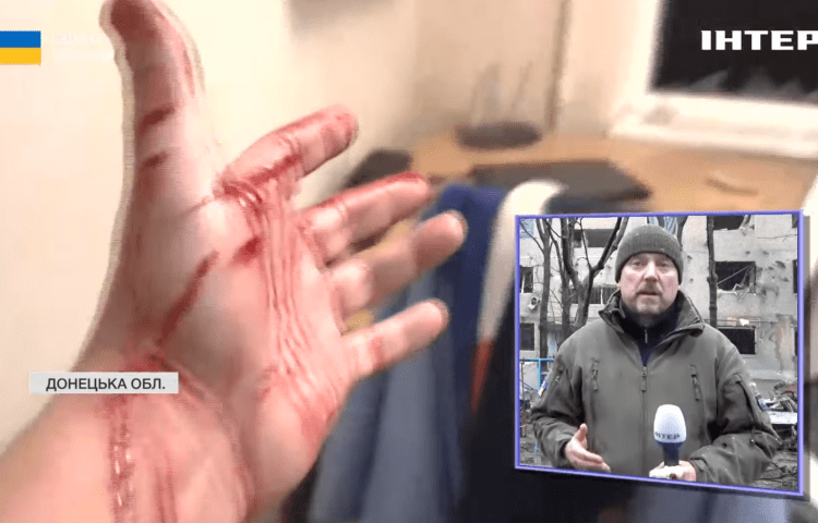 Igor Levinok, a war correspondent with the privately owned Ukrainian TV channel Inter, was injured by a Russian bomb on February 8.