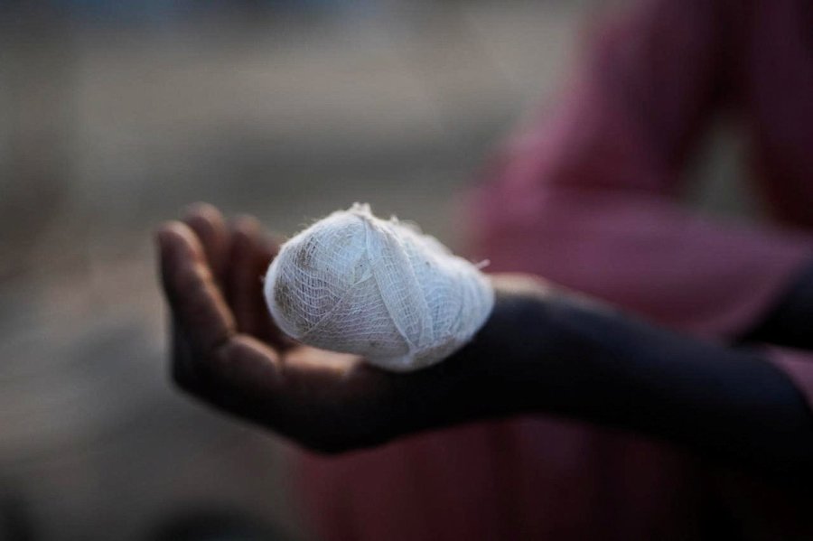 A child shows an injured hand at a camp for displaced people who fled from al-Fashir to Tawila, North Darfur, Sudan, on October 27, 2025.